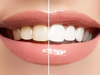 Appleseed Dental | Dentures, Dental Cleanings and Dental Sealants